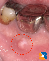 膿みで歯茎が膨らむ