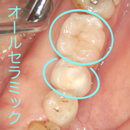 神経を抜かない