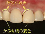黄色い歯とホワイトニング