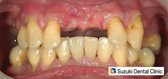 失った前歯を入れ歯でカバー