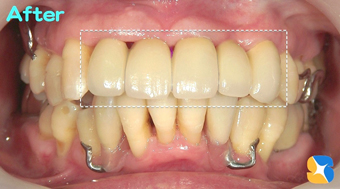 上：前歯にセラミックの５連結装着