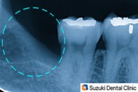 抜歯後：短時間でスムーズな抜歯
