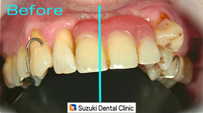 前歯は見た目に影響を与えます