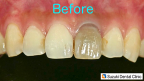 治療前／白い歯を希望