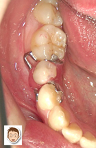 試作のミニ入れ歯でチェック