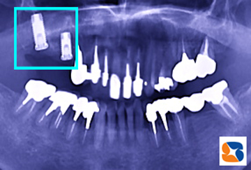 ２本のインプラントをレントゲンで確認