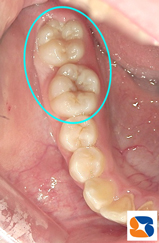 小学生　奥歯の茶色の溝