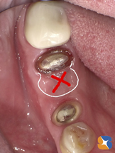 奥歯を抜歯　インプラント