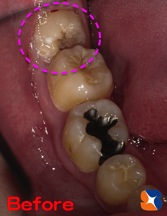 横向きの親知らずの為、手前が虫歯