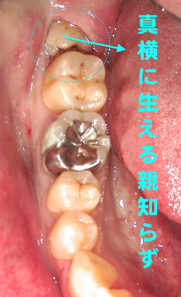 横向きの親知らず