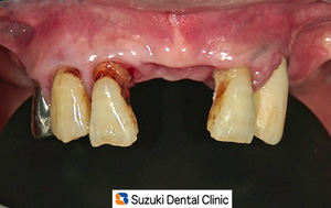 旧入れ歯を外した状態
