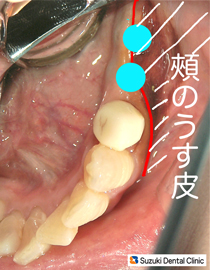インプラントに不向きな歯茎