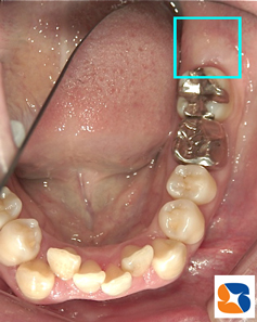 一部分すら見えない親知らずの抜歯