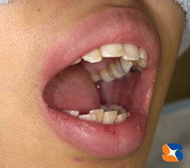 親知らずが原因で口が空かない