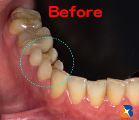 銀の詰め物　セラミックの白い詰め物　選択