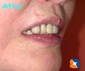 鈴木歯科医院の入れ歯