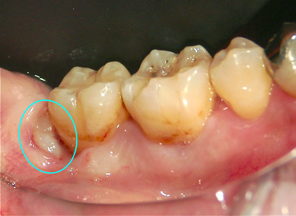 横向きに生える親知らず