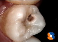 激しい痛みを伴う大きな虫歯