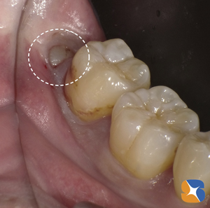 歯医者が抜きたくない親知らず