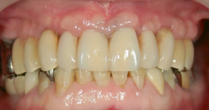 上の歯はすべてインプラント