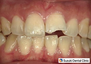 こけて前歯が割れた