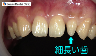 細い前歯