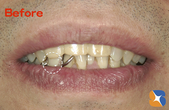 金具が目立つ入れ歯