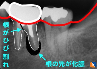 奥歯には根が２本ある