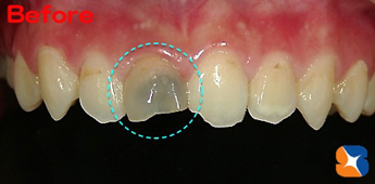 神経を抜いてから７年後