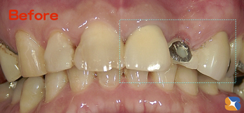 保険の前歯のブリッジ