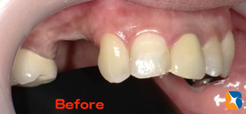 インプラント摘出後の歯茎