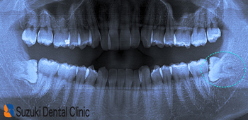 横向きの親知らず