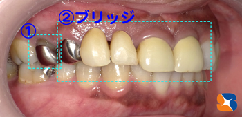 昔は銀歯、今は白い歯が保険で可能