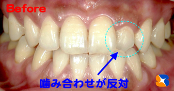１本反対の噛み合わせ