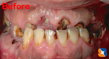 虫歯で歯がモロモロ