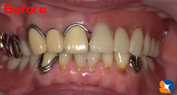 噛めない入れ歯　見た目の悪い入れ歯