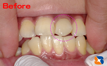 前のさし歯　お子様の将来