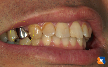 ２年前までは保険で銀歯