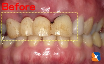 ブリッジの変色が気になる