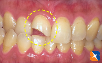 前歯の噛み合わせが悪いトラブル