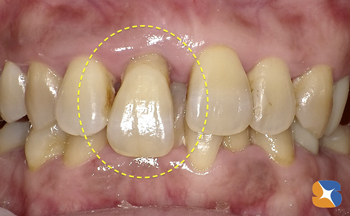 何処行っても抜歯　セカンドオピニオン　