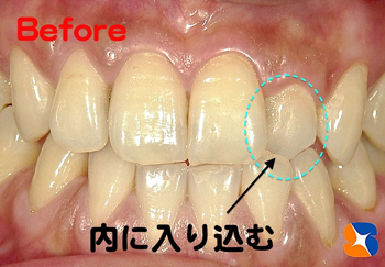 前歯が１本中に入り込む