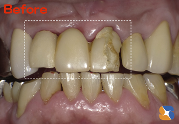 前歯　ブリッジ　保険で高品質
