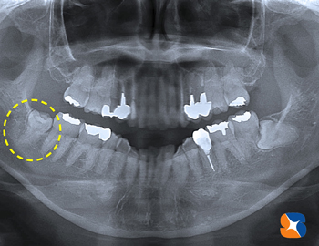 遠方から親知らずの抜歯