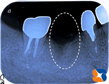 奥歯　抜歯　ない