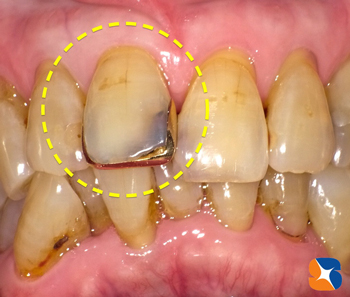 前歯に金を被せたお婆ちゃん