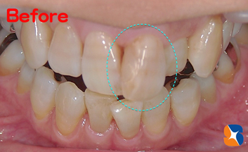 突出の前歯を矯正以外で治す方法
