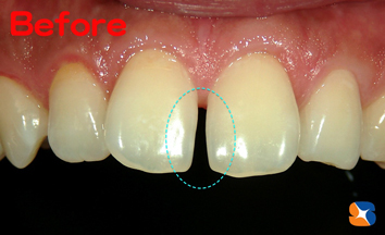 前歯の隙間