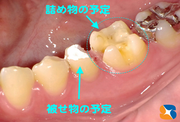 奥歯の治療　セラミックス予定