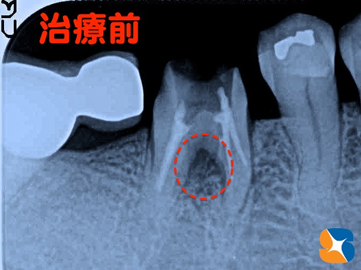 歯茎が膿んでいた所をレントゲンで確認